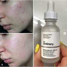 The Ordinary Niacinamide 10% + Zinc 1 % - 30ml |Oil Control, Pore Minimizing & Blemish Solution Serum|